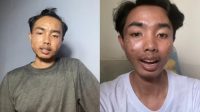 Bahaya_Thrifting_Pria_Ini_Idap_Penyakit_Kulit_Parah_Akibat_Baju_Bekas