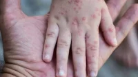 Mpox di Indonesia: Gejala, Penyebab, Penanganan Terbaru & Data