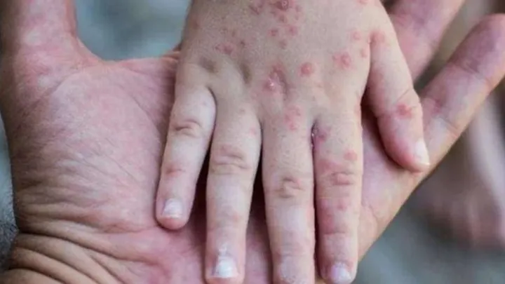 Mpox di Indonesia: Gejala, Penyebab, Penanganan Terbaru & Data