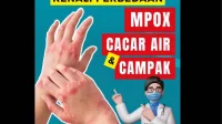 Mpox vs Cacar Air vs Campak: Kenali Gejala & Pencegahannya