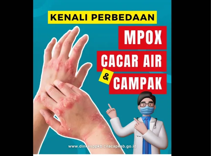 Mpox vs Cacar Air vs Campak: Kenali Gejala & Pencegahannya