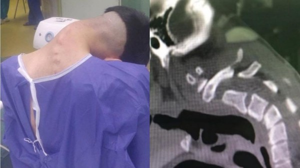 Sindrom Kepala Jatuh: Leher Bengkok, Otot Lemah, Kisah Nyata