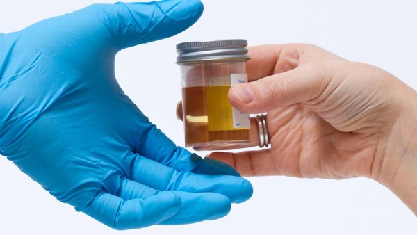 Urine Berbusa? Waspadai 5 Penyakit Serius Ini!