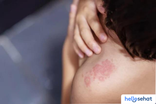 Atasi Gigitan Tomcat Secara Efektif: Panduan Pertolongan Pertama