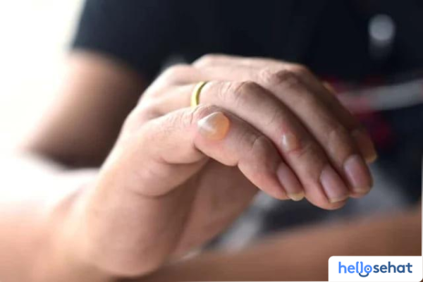 Atasi Kulit Melepuh: Penyebab, Pencegahan, dan Pengobatan Terbaik