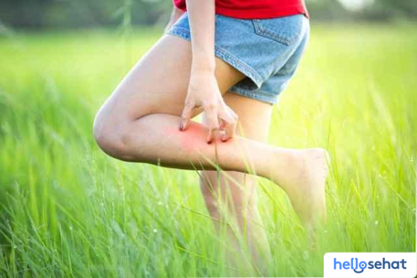 Obat Sengatan Tawon Ampuh? Pertolongan Pertama & Pencegahannya