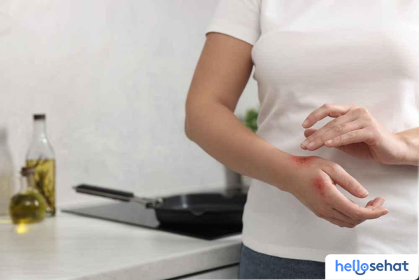 Obati Luka Bakar Minyak Panas: 7 Cara Ampuh Cepat Sembuh